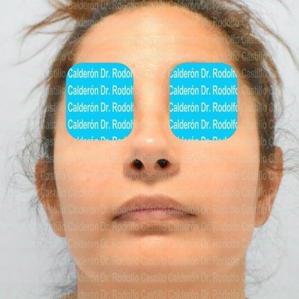 Rhinoplasty: Secondary Rhinoplasty - Case1 - Before