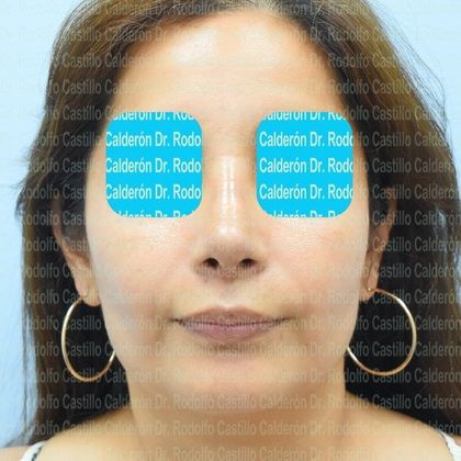 Rhinoplasty: Secondary Rhinoplasty - Case1 - After