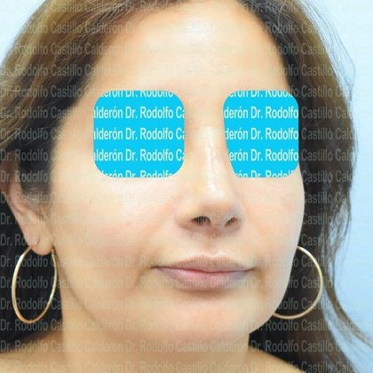 Rhinoplasty: Secondary Rhinoplasty - Case1 - After