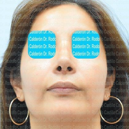 Rhinoplasty: Secondary Rhinoplasty - Case1 - After