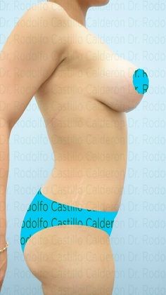Mommy Makeover -Abdomen, Breast, Lipo, BBL-: Tummy Tuck + Breast Lift with implants - After