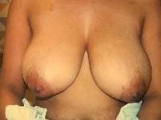 Breast Augmentation: Case 13 - Before