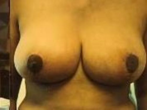 Breast Augmentation: Case 13 - After