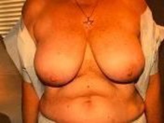 Breast Augmentation: Case 10 - Before