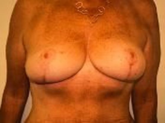 Breast Augmentation: Case 10 - After