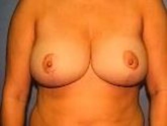 Breast Augmentation Case 14 - After