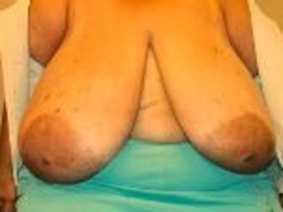 Breast Augmentation: Case 15 - Before