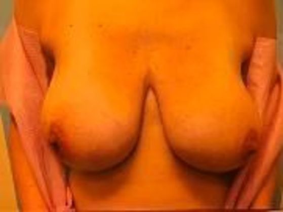 Breast Augmentation: Case 16 - Before