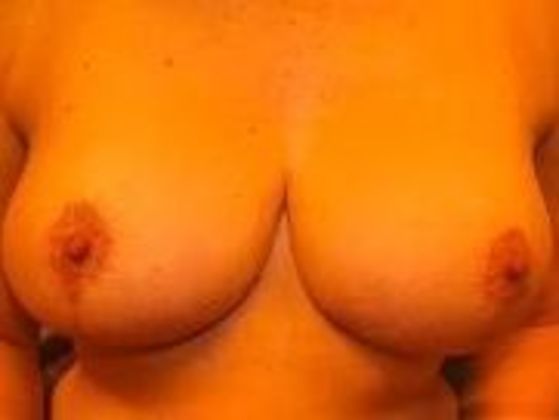 Breast Augmentation: Case 16 - After