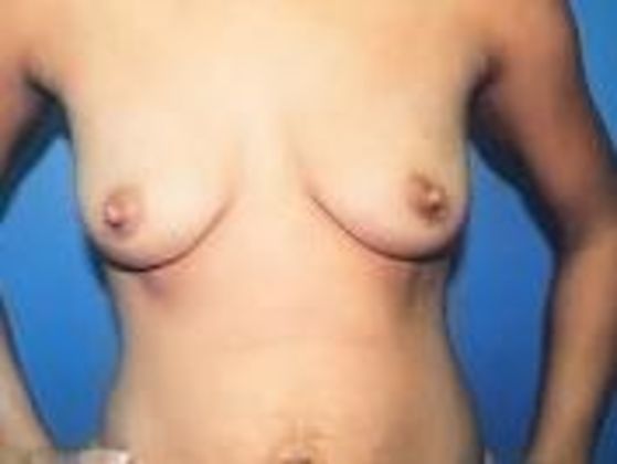 Breast Augmentation Case 17 - Before