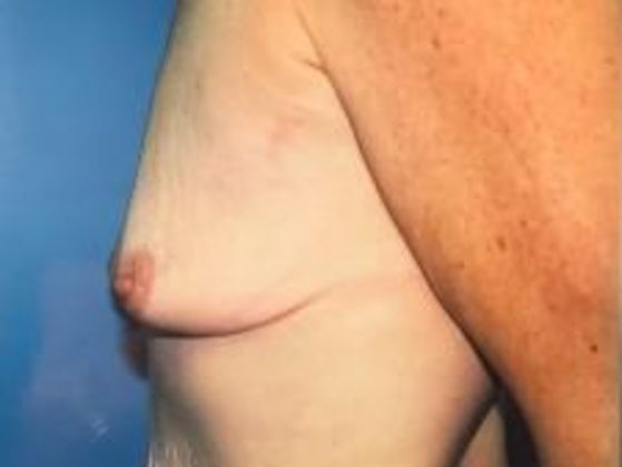 Breast Augmentation Case 18 - Before
