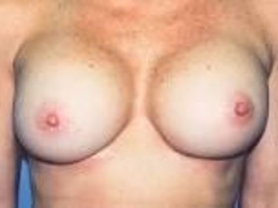 Breast Augmentation Case 20 - After