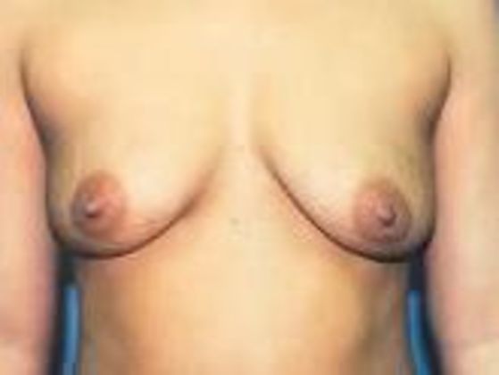 Breast Augmentation Case 19 - Before