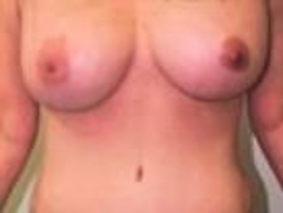 Breast Augmentation: Case 22 - After