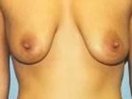 Breast Augmentation: Case 23 - Before