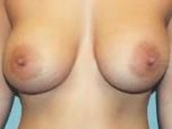 Breast Augmentation: Case 23 - After