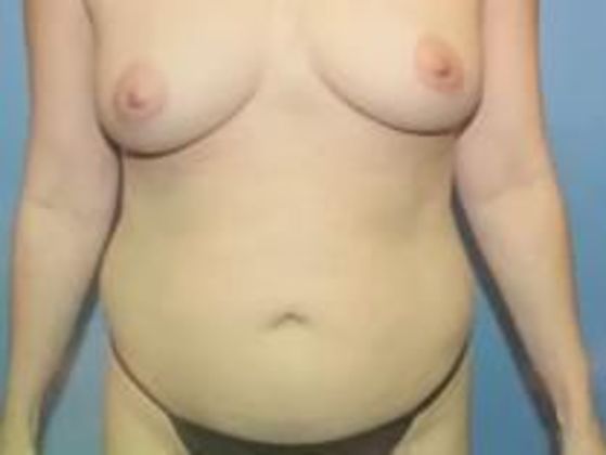 Tummy Tuck Case 7 - Before