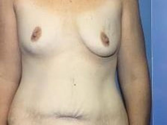 Tummy Tuck Case 8 - Before