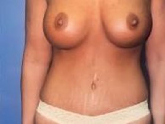 Tummy Tuck Case 8 - After