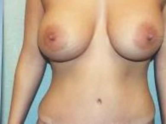 Tummy Tuck: Case 9 - After