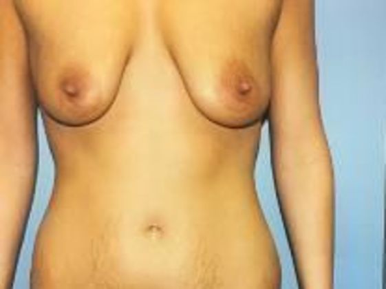 Tummy Tuck: Case 9 - Before