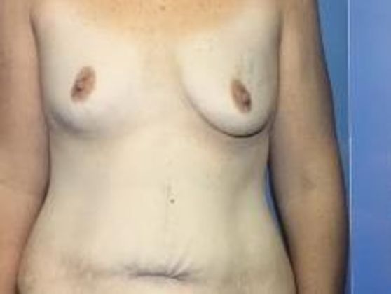 Mommy Makeover: Case 4 - Before