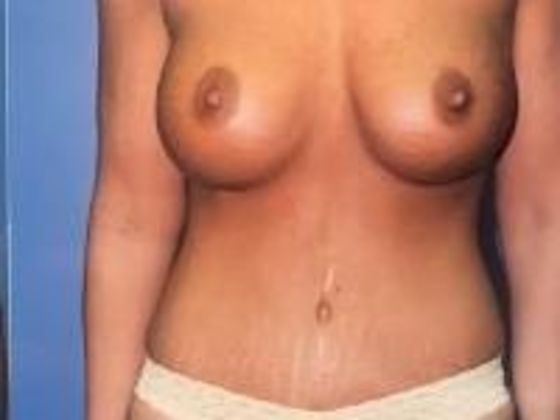 Mommy Makeover: Case 4 - After