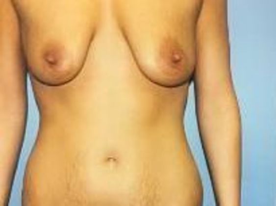 Mommy Makeover Case 5 - Before