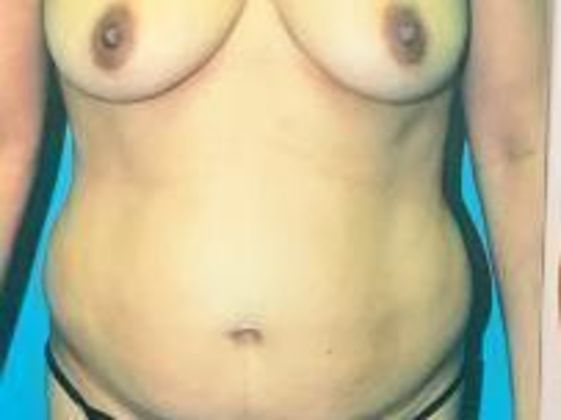 Mommy Makeover: Case 6 - Before