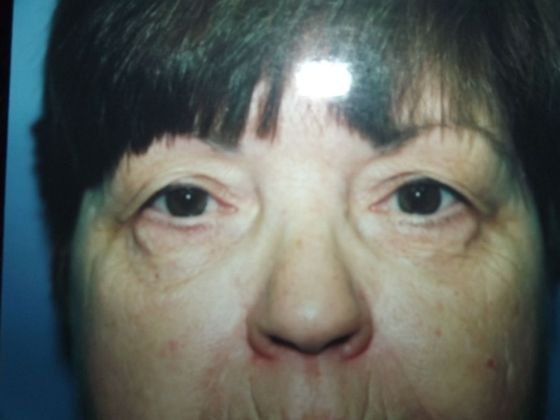 Blepharoplasty Case 3 - Before