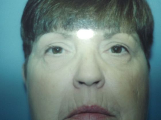 Blepharoplasty Case 3 - After