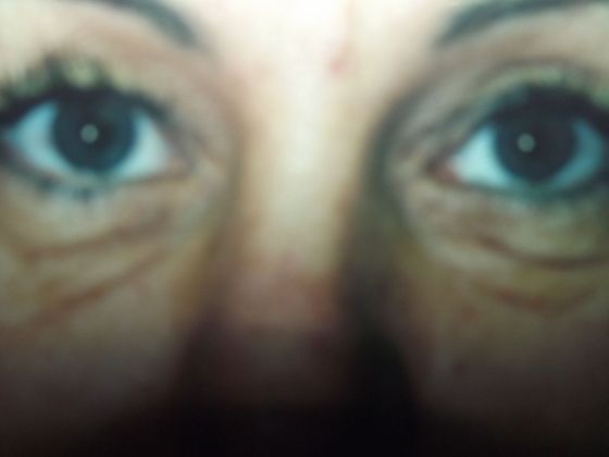 Blepharoplasty: Case 4 - Before