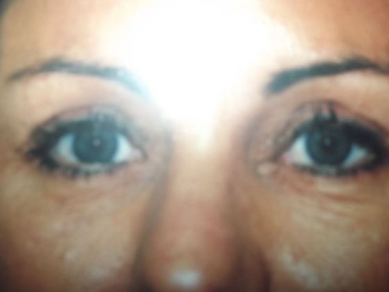 Blepharoplasty: Case 4 - After