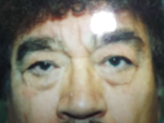 Blepharoplasty Case 5 - Before