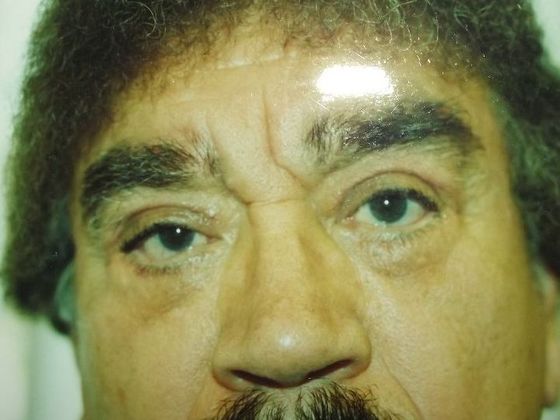 Blepharoplasty Case 5 - After