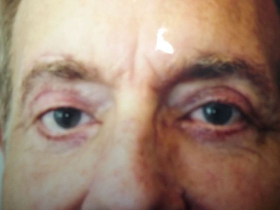 Blepharoplasty: Case 6 - After