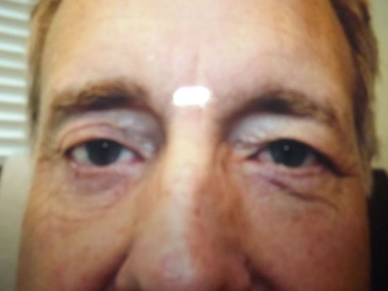 Blepharoplasty: Case 6 - Before