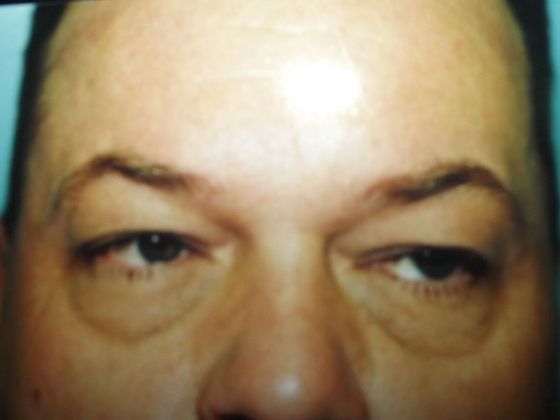Blepharoplasty: Case 7 - Before