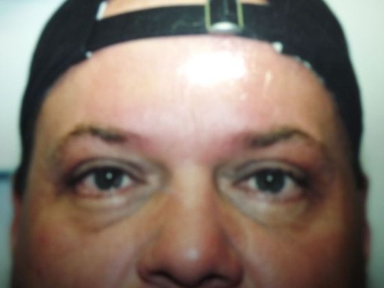 Blepharoplasty: Case 7 - After