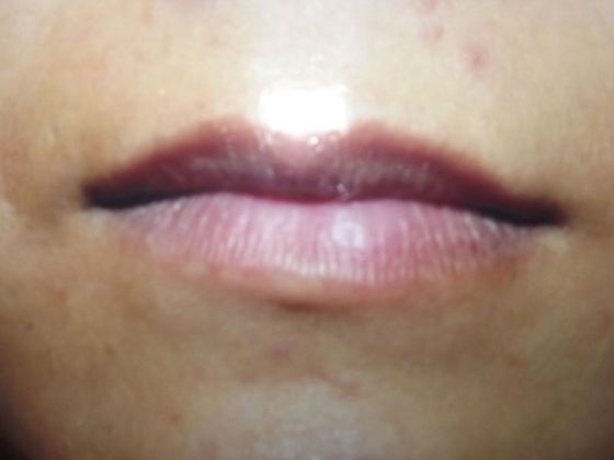 Lip Augmentation Case 1 - Before