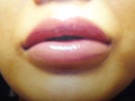 Lip Augmentation Case 1 - After