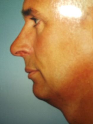 Neck Lift Case 2 - Before