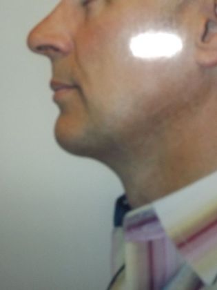 Neck Lift Case 2 - After