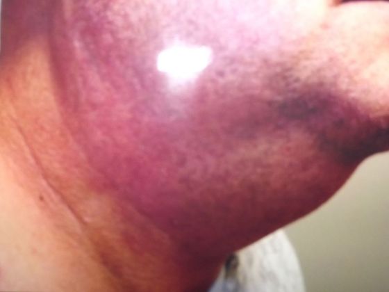 Neck Lift Case 3 - Before