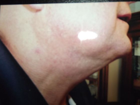 Neck Lift Case 3 - After