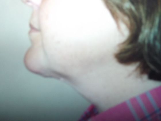 Neck Lift: Case 4 - Before