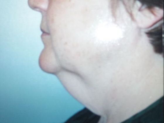 Neck Lift: Case 4 - Before