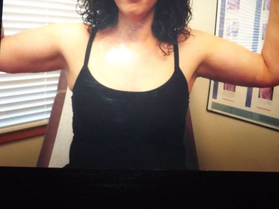 Brachioplasty Case 2 - After