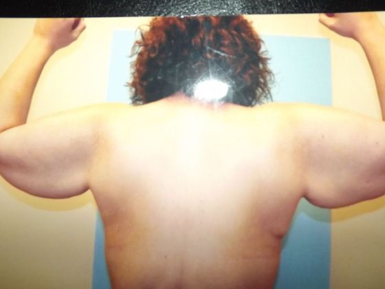 Brachioplasty Case 2 - Before