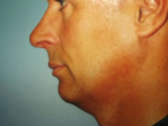 Chin Augmentation Case 2 - Before